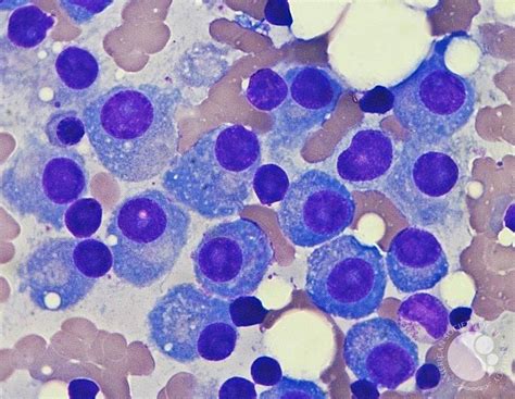 Multiple myeloma - Bone marrow smear 2