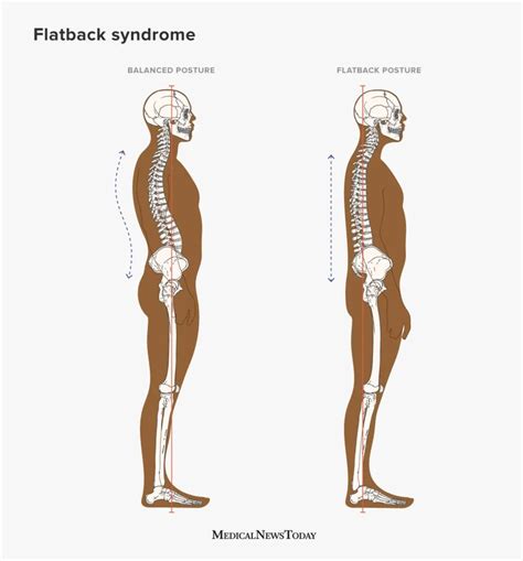 Flatback syndrome: Symptoms, treatment and causes