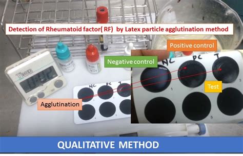 Rheumatoid factor: Introduction, associated diseases, detection