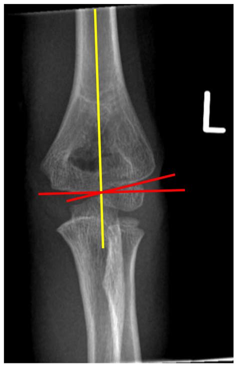 Common Paediatric Elbow Injuries