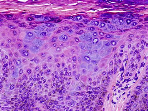 Epidermodysplasia Verruciformis Histology