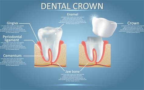 5 Benefits of a Dental Crown