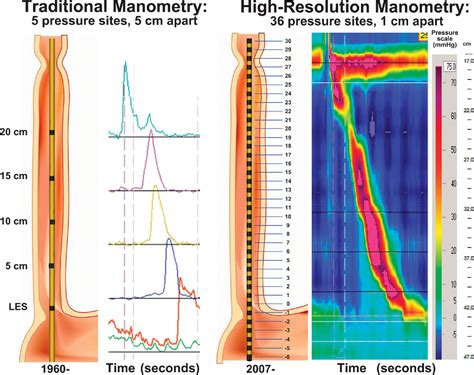 A Primer of High-Resolution Esophageal Manometry - Seminars in Thoracic ...