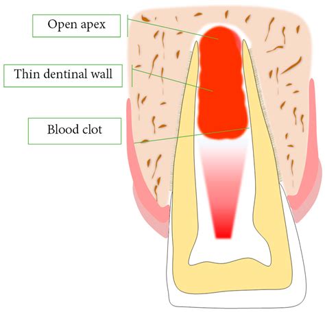 Bioengineering | Free Full-Text | Photobiomodulation Therapy and Pulp ...