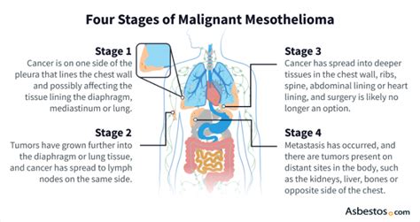 Mesothelioma Symptoms | Guide to Symptoms by Stage & Diagnosis