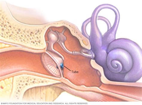 Tympanostomy tubes - Mayo Clinic