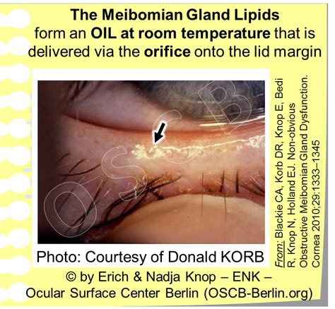 GLIMPSE of ... The MEIBOMIAN GLAND — Ocular Surface Center Berlin