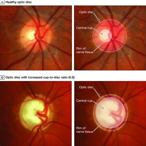 Do Findings on Routine Examination Identify Patients at Risk for Primary Open-Angle Glaucoma?The ...