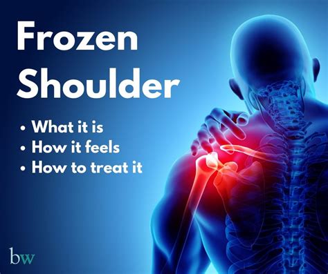 Frozen Shoulder - The Bodyworks Clinic Marbella Spain