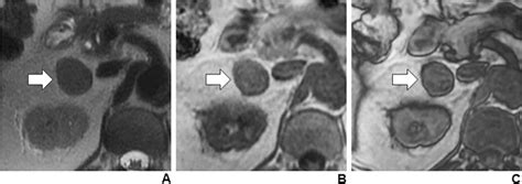 48-year-old female with right lipid-poor adrenal adenoma. A Axial T2W... | Download Scientific ...