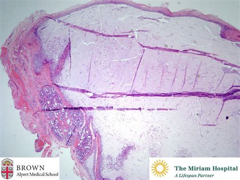 Mucocele