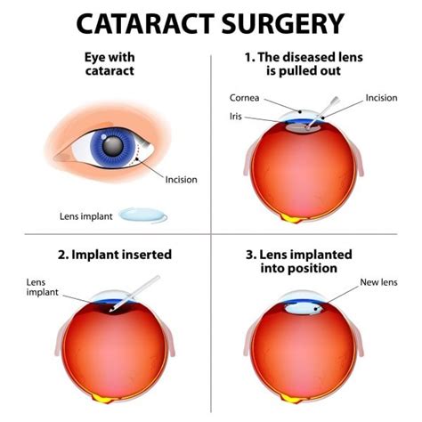 What Are The Symptoms of Cataracts? — iCare Family Vision