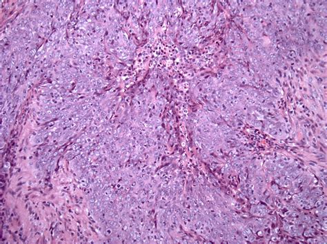 Nasopharyngeal Carcinoma Stickbynik