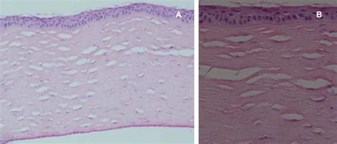 Histology of the cornea in a treated eye three months after surgery ...