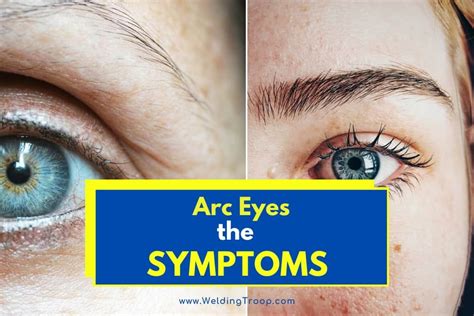 What is Arc Eye? (Welder Flash + Symptoms?)