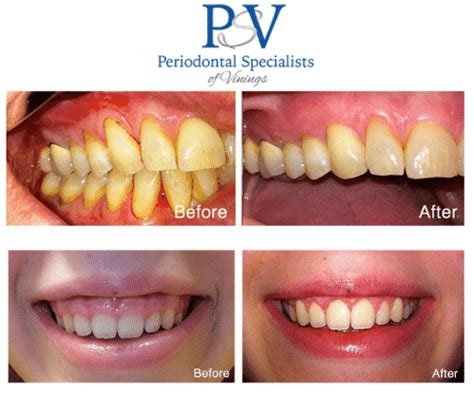 Periodontics • Periodontist and Dental Implants Atlanta