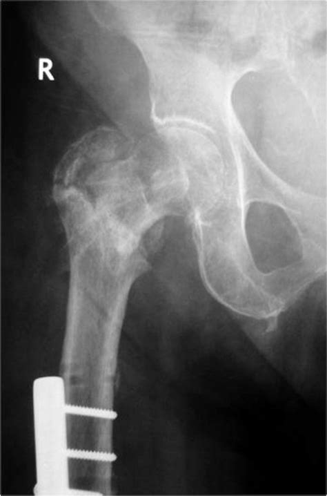 Complications. Re-fracture occurred after external fixator removal in... | Download Scientific ...