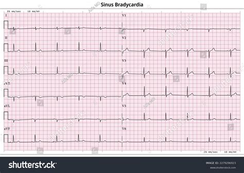 Ecg Sinus Bradycardia 12 Lead Ecg Stock Vector (Royalty Free) 2279296923 | Shutterstock