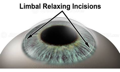 Limbal relaxing incision - #SURLR0004 | Stock eye images