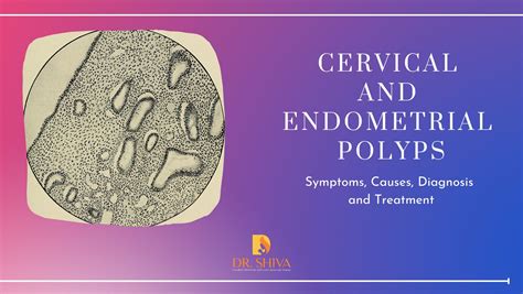 Cervical and Endometrial polyp | Cause and Treatment