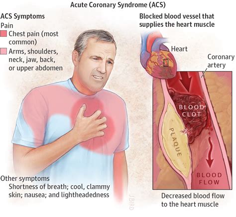 Acute Coronary Syndrome | Acute Coronary Syndromes | JAMA | JAMA Network