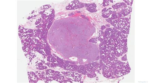 Well differentiated neuroendocrine tumour of the pancreas | Ottawa ...