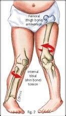 Excessive femoral anteversion causes increase in hip internal rotation. It usually occurs in ...