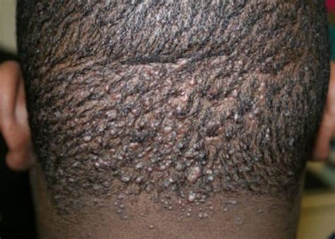 Cancer Bumps On Scalp