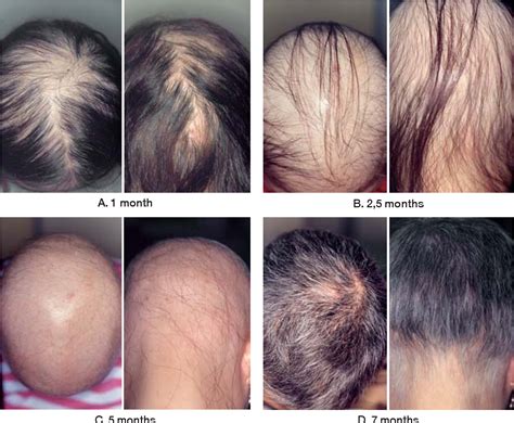 Figure 3 from Acute alopecia totalis. | Semantic Scholar