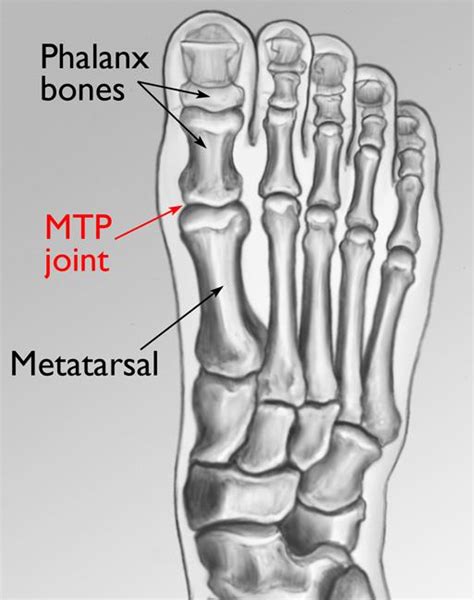 Bunions - OrthoInfo - AAOS