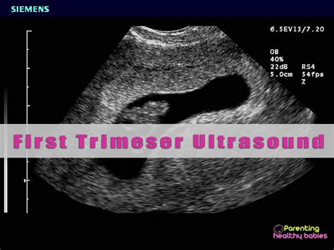 first trimester ultrasound scans