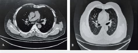 (A) CT thorax showing resolution of the right rib cage collection. (B ...