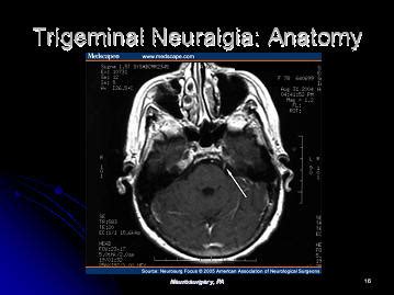 Trigeminal Nerve Mri