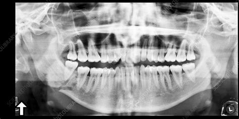 Broken jaw, X-ray - Stock Image - C017/7557 - Science Photo Library