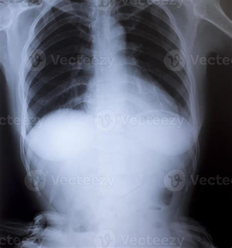 X-Ray Image Of Human Chest for a medical diagnosis 936894 Stock Photo at Vecteezy