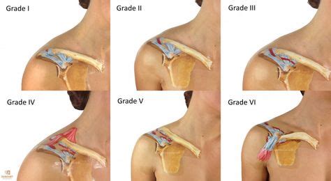 AC Joint Injuries Grade I-VI | Shoulder arthritis, Rotator cuff surgery ...