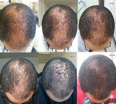 Minoxidil Before and After Photos [2022] | Is it right for you?