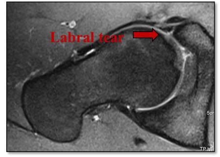 Femoroacetabular Impingement (FAI) | Baton Rouge, LA | Hip Arthroscopy ...