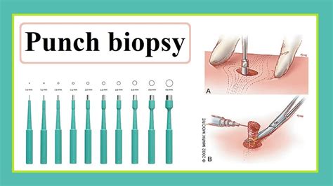 Biopsy Punch