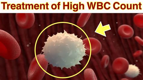 Treatment of High WBC Count | Natural Treatment of High White Blood Cells | Treatment of ...