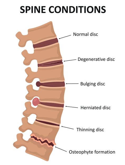 Spine Disorders | Ohio State Medical Center