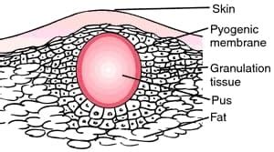 COLD ABSCESS - New