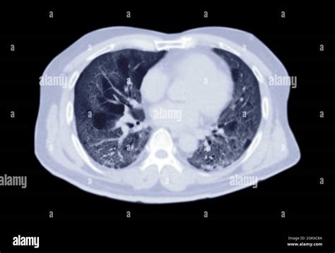 CT scan of Chest or lung axial view of lung infection covid-19 with ...