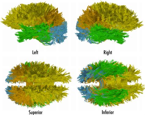 Illustration of the tractography results for a single subject presented... | Download Scientific ...