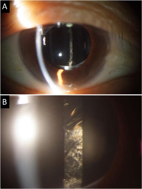 Figure 1 from Findings in pseudophakic eye that developed liquefied aftercataract-like substance ...