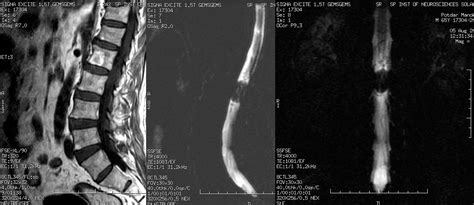 Dr Balaji Anvekar FRCR: Intraspinal mass, a nerve sheath tumor on MRI; Importance of MR Myelography