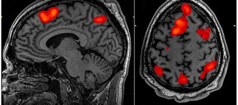 MRI Scan Detects Signs of Schizophrenia: Brain imaging test predicts ...