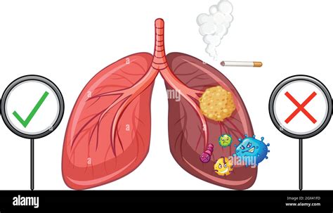 Cancer of lungs Cut Out Stock Images & Pictures - Alamy