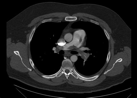 Subsegmental pulmonary embolism: Prognosis and Treatment