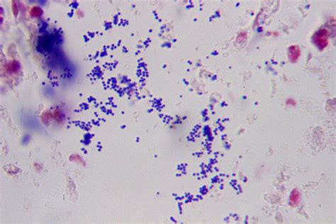 File:Purulent inflammation, Gram stain 3.jpg - Wikimedia Commons